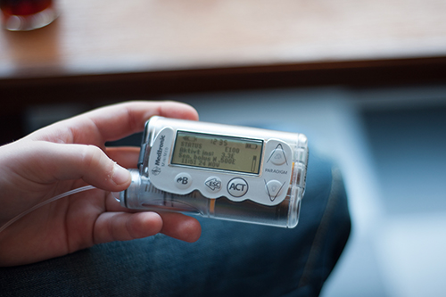 En insulinpump kan förbättra överlevnaden hos personer med typ 1-diabetes. Typ 1-diabetes drabbar främst unga personer. Foto: Shutterstock